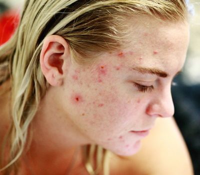adult with acne