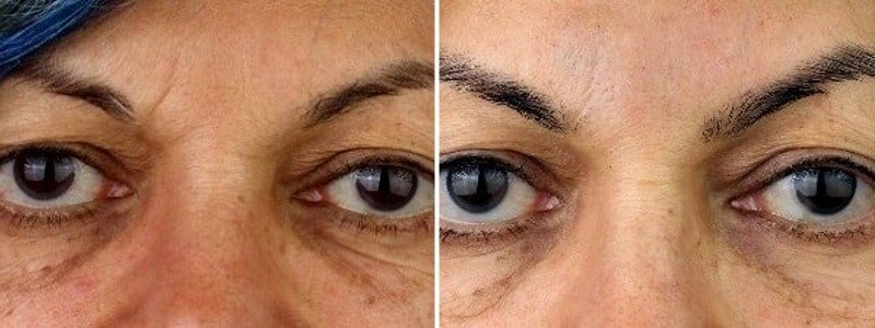 before and after botox PDO Threads