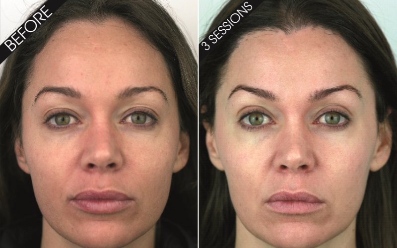 Before and After MesoPeptides
