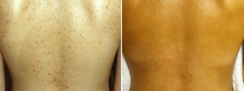Before + After Acne Back Treatment