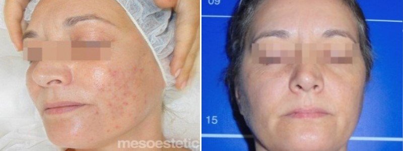 Before + After Acnelan Treatment