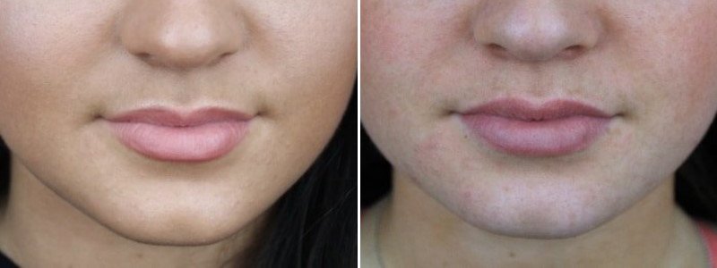 Before + After Dermal Filler Lips