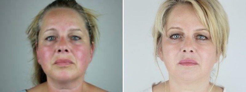 Before + After Exquisite Facial