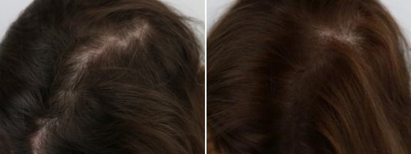 Non-Surgical Hair Loss Treatments | Clinicbe London