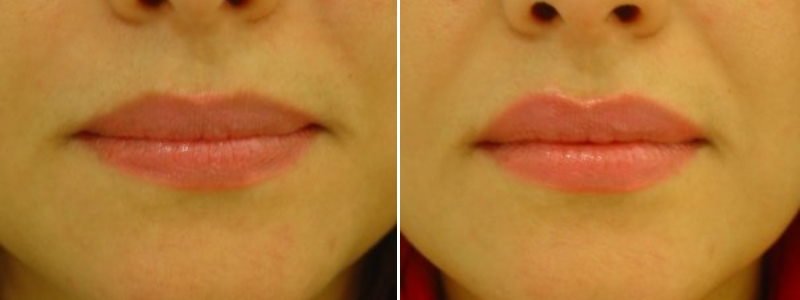 Before + After Lip Fillers