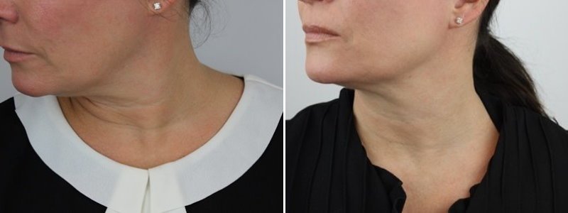 Before + After Neck Treatment