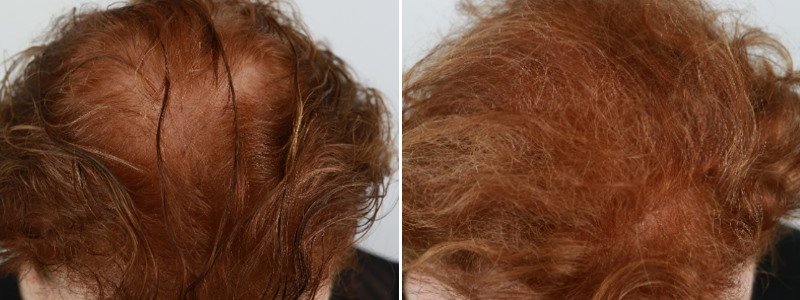 7 Week Non-Surgical Hair Restoration | Clinicbe London