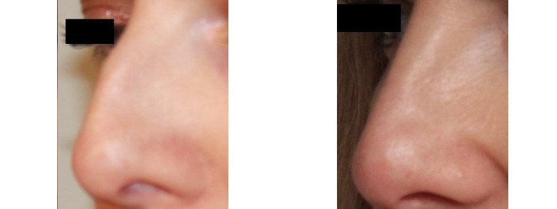 Before + After Nose Job