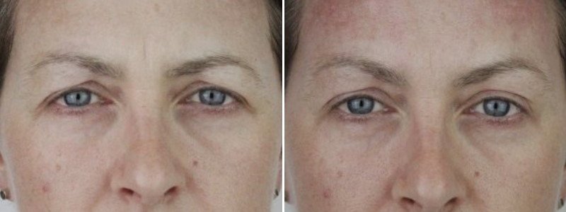 Before + After PDO Eyebrow Thread Lift Hooded Eyes