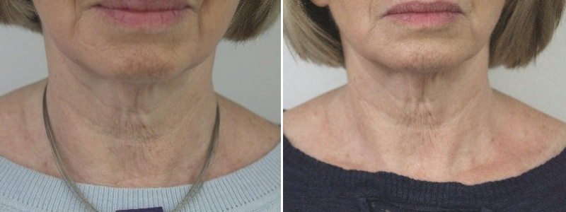 Before + After Skinboosters Neck