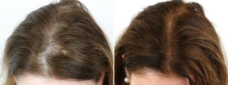 Non-Surgical Hair Restoration Results