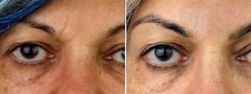 Before + After anti-wrinkle injections with PDO Threads