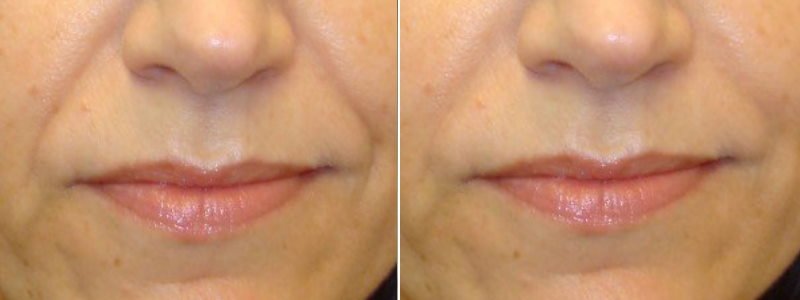 before + after nasolabial folds