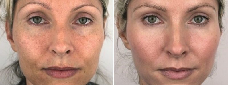 before and after azzalure + dermal fillers