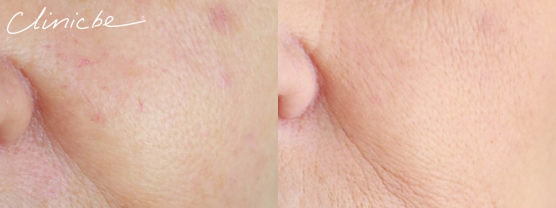 Before and after thermavein