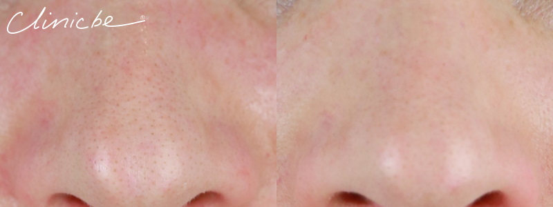 Thermavein treatment results