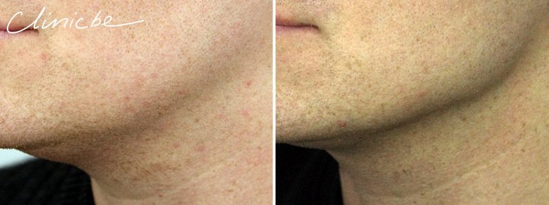 before and after male aqualyx + fillers