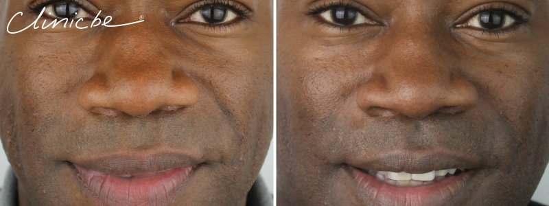 before and after male microdermabrasion