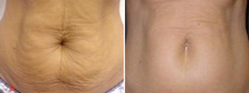Carboxytherapy Abs Treatment Results