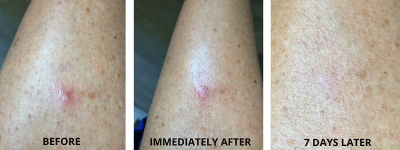 Carboxytherapy Acne Treatment Results