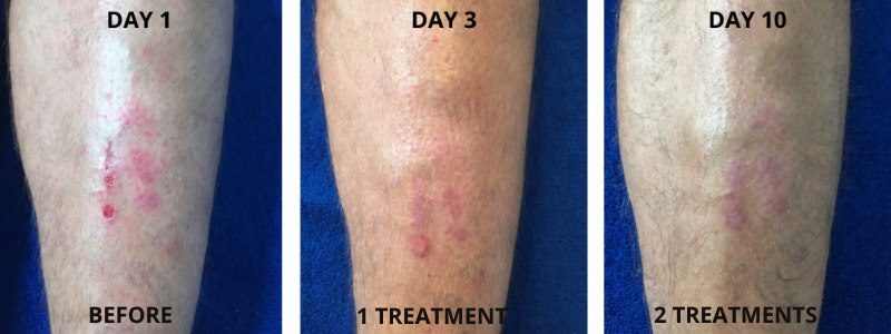 Carboxytherapy Eczema Treatment Results