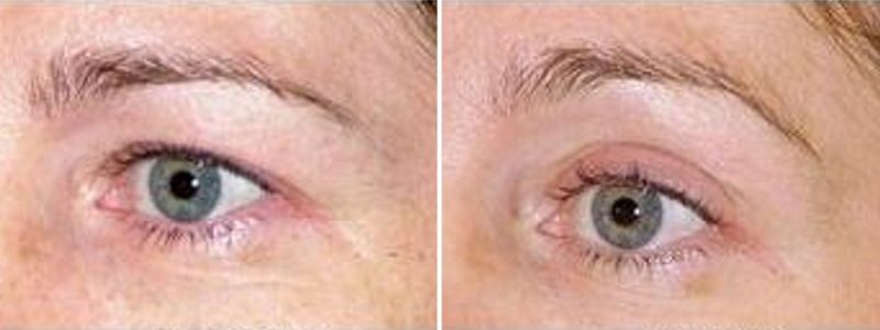 Carboxytherapy Eye Treatment Results
