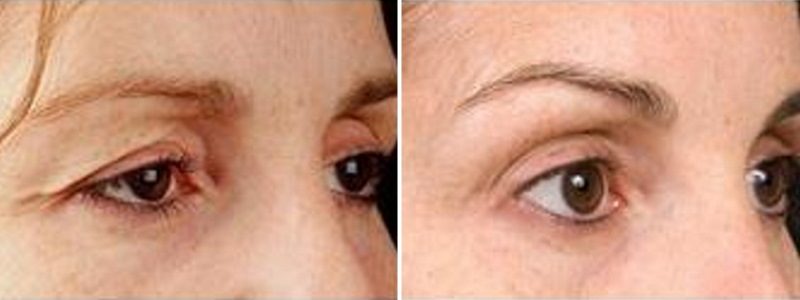 Carboxytherapy Eyes Treatment Results