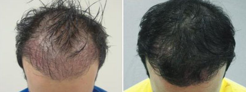 Carboxytherapy Hair Loss Treatment Results
