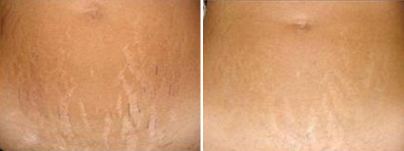 Carboxytherapy Stretch Marks Treatment Results