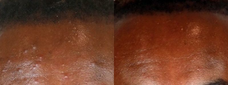 Before and After Chemical Peel Plasma Shower Medical Skincare
