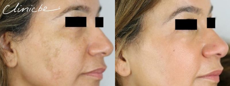 Before and After Meline Melasma Treatment