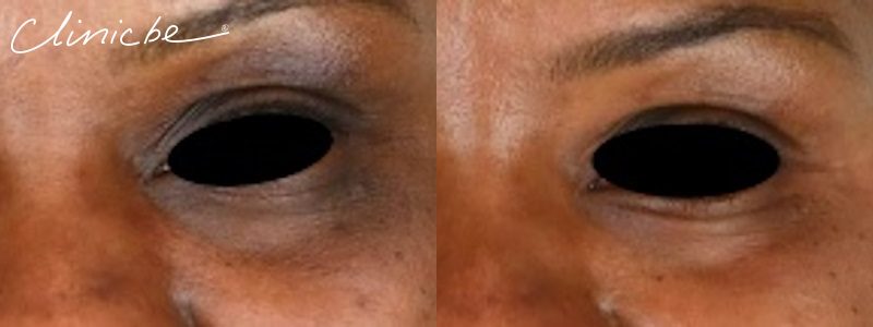 Before and After Meline Pigmentation Treatment