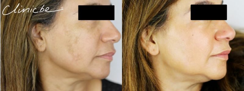 Me-Line pigmentation treatment results